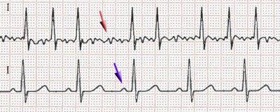 I.INTRODUCCIÓN (1) ECG: - Actividad auricular desorganizada sin ondas P -