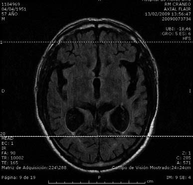 Figura 2. Resonancia magnética cerebral (2009). El examen muestra un contraste correcto entre la sustancia blanca y la gris.