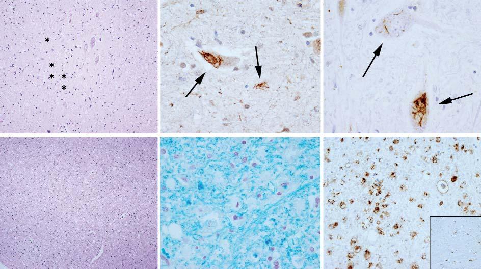 A B C D E F Figura 4. Alteraciones neuropatológias tipo ELA. a-c) Pérdida de neuronas motoras del asta anterior de la médula espinal (a: asteriscos, hematoxilina-eosina x 200).