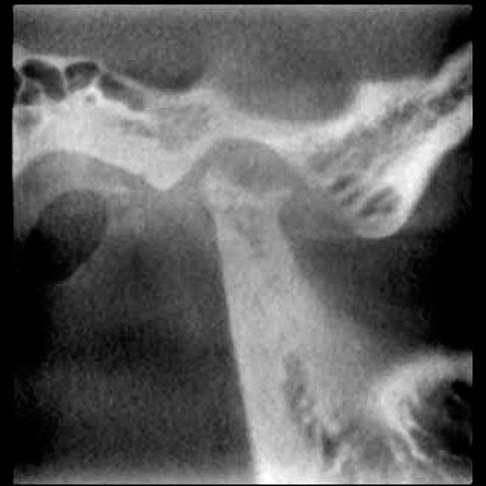 mandibular se afecta en una etapa más avanzada del compromiso óseo degenerativo de la ATM, el cual puede presentar