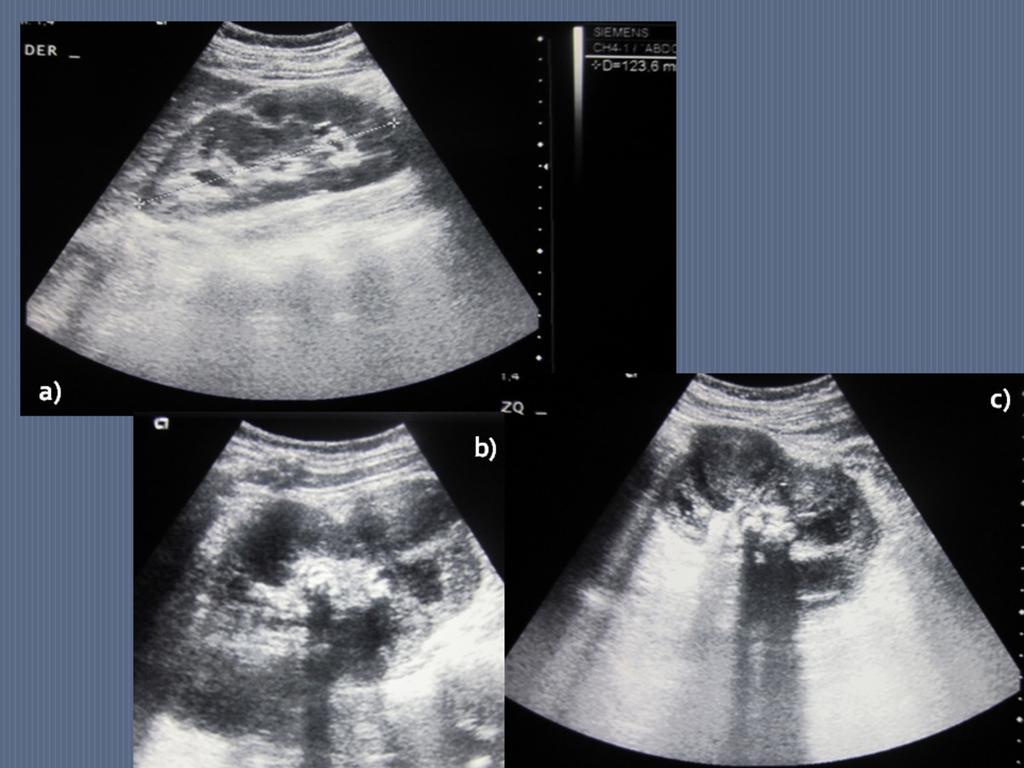 Fig. 5: Mujer de 38 años con dolor en fosa renal izquierda, nauseas, fiebre y alteración de la función renal en la analítica.