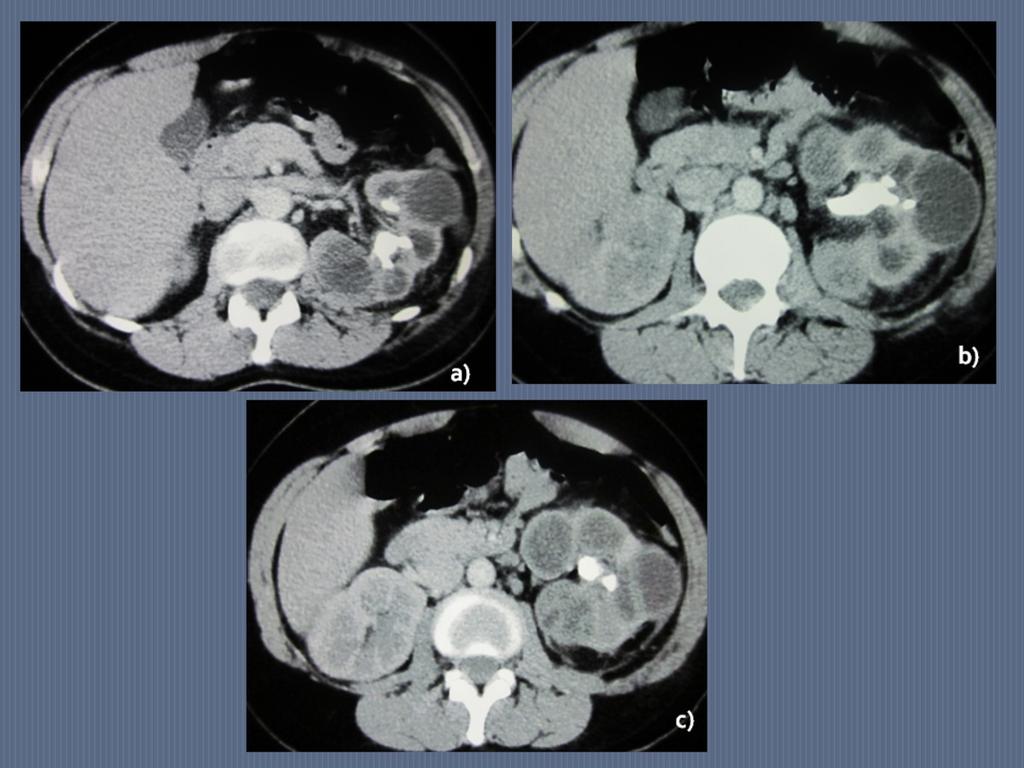 Fig. 6: (a-c) Cortes axiales de TC de abdomen con contraste de la misma paciente.