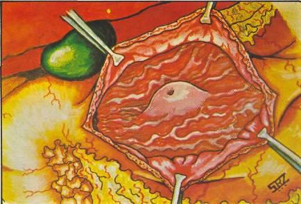 REV. MEDICA HONDUR. VOL. 48-1980 pancreático ubicada fuera de los confines normales del páncreas, lo que la hace un coristoma.