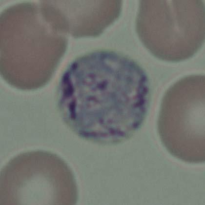 Pigmento palúdico distribuido uniformemente. Plasmodium falciparum En la sangre periférica normalmente sólo se observan trofozoítos y gametocitos.