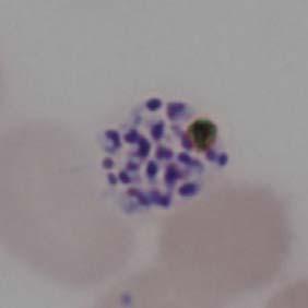 Color del citoplasma: normal, pero a veces presenta un tinte azulado. Infecciones múltiples: comúnmente. b) Trofozoíto Joven: forma de anillo de pequeñas dimensiones.