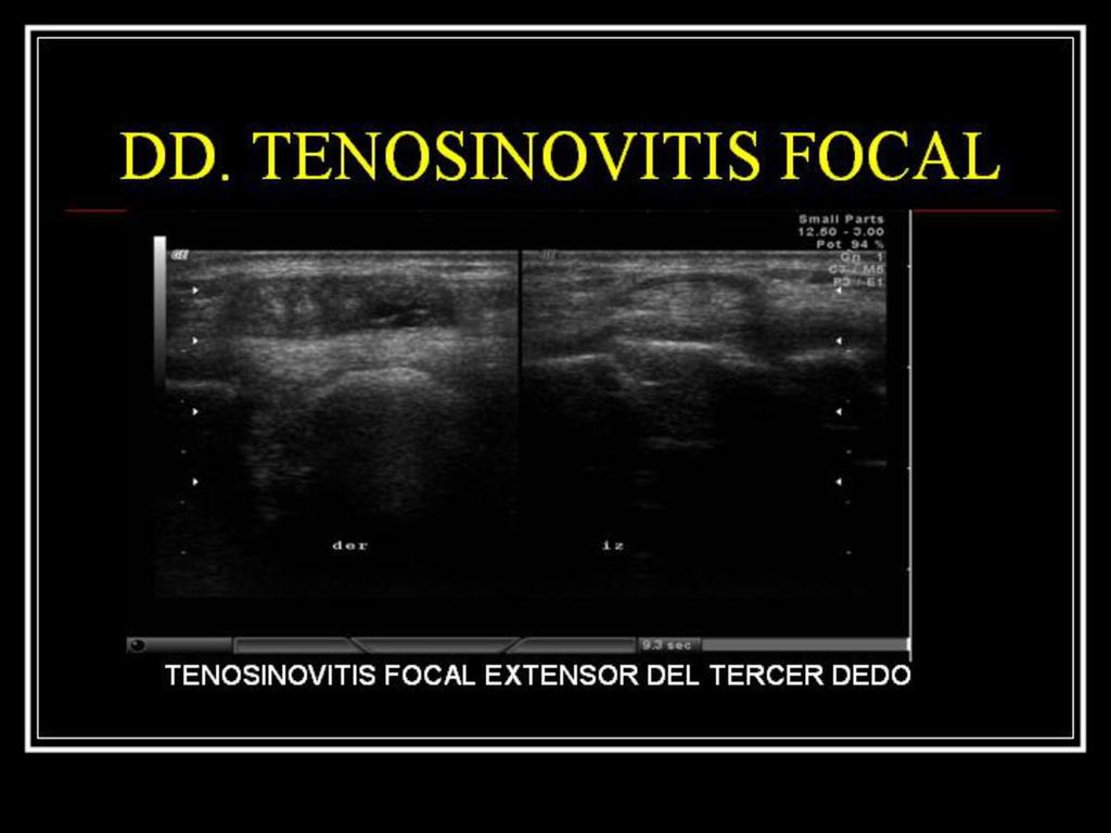 Fig. 14: Imagen ecográfica que muestra una tumoración anecoica focal adyacente al