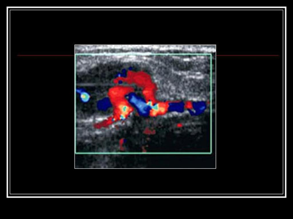 Fig. 16: Imagen ecográfica que muestra una fístula arterio-venosa secundaria a un un corte en la mano.