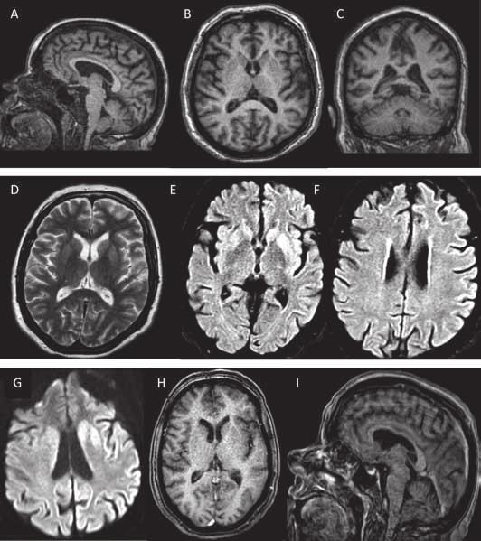 Figura 4. RMN de cerebro 1.5 Teslas. A, B, C: secuencias T1WI sagital, axial y coronal respectivamente. No se aprecian alteraciones morfológicas llamativas en estas imágenes.