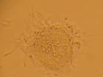 Figura 2. Cultivo de una muestra patológica de glioblastoma multiforme, que presenta una neuroesfera típica. Cortesía de la Dra.