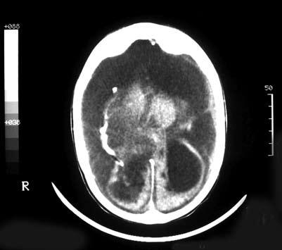 La rápida descompresión de los VL provoca colapso del parénquima cerebral y estiramiento y desgarro de las venas emisarias, propiciando la formación de hematomas o higromas subdurales. (4) (Fig.