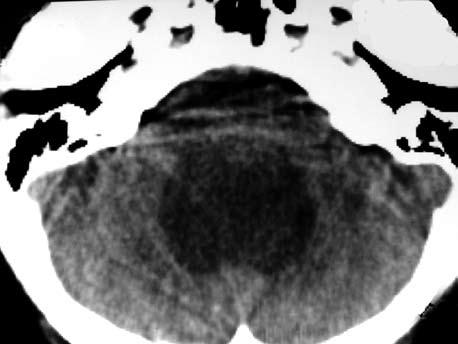 (4) Lo característico en la imagen es que el IV ventrículo está aumentado de tamaño redondeado o en forma de pera en la fosa posterior, debido a que los plexos coroideos producen LCR que no se puede