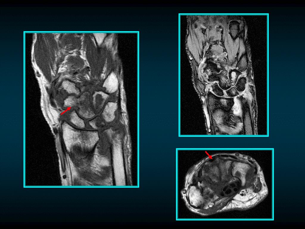 Fig. 10: Paciente con antecedente de artritis reumatoide. RM con secuencias potenciadas en T1 en los planos coronal y axial, y STIR en el plano coronal.