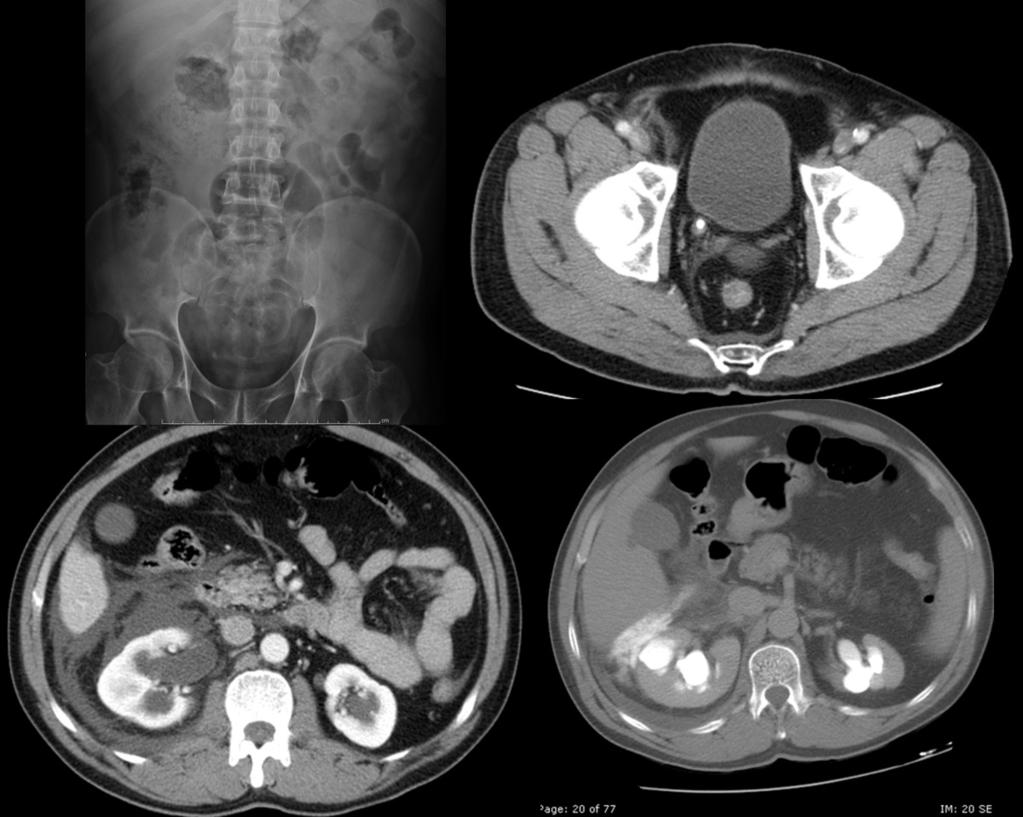 Fig. 3: Hombre de 47 años que acude por dolor clínica de cólico nefritico derecho, observando en RX simple de abdomen (arriba izquierda) una litiasis a la altura de unión ureterovesical derecha que