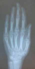 crecimiento óseo 8, (osificación total de la línea epifisiaria en la falange media del tercer dedo) los resultados de este análisis muestran que la paciente paso el periodo de máxima aceleración del