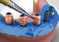 3 Colocación de los cilindros sobre los implantes