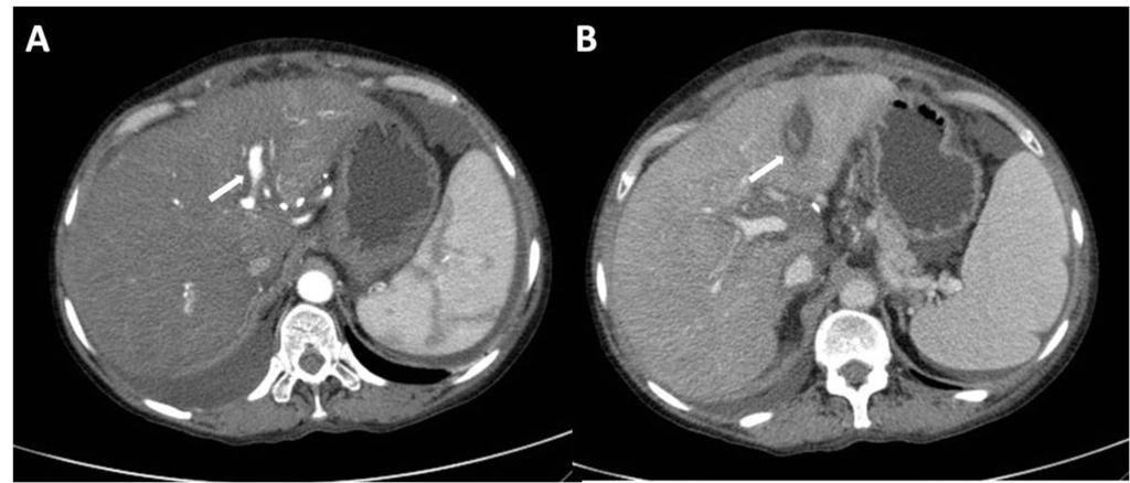 Fig. 7: Shunt arterio-portal (flechas).