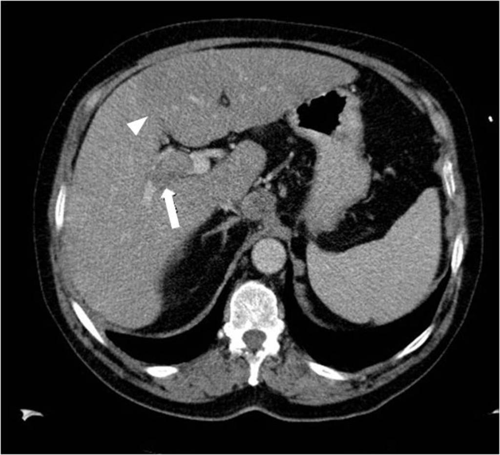 Fig. 8: Trombosis portal (flecha) con alteración de la perfusión del lóbulo
