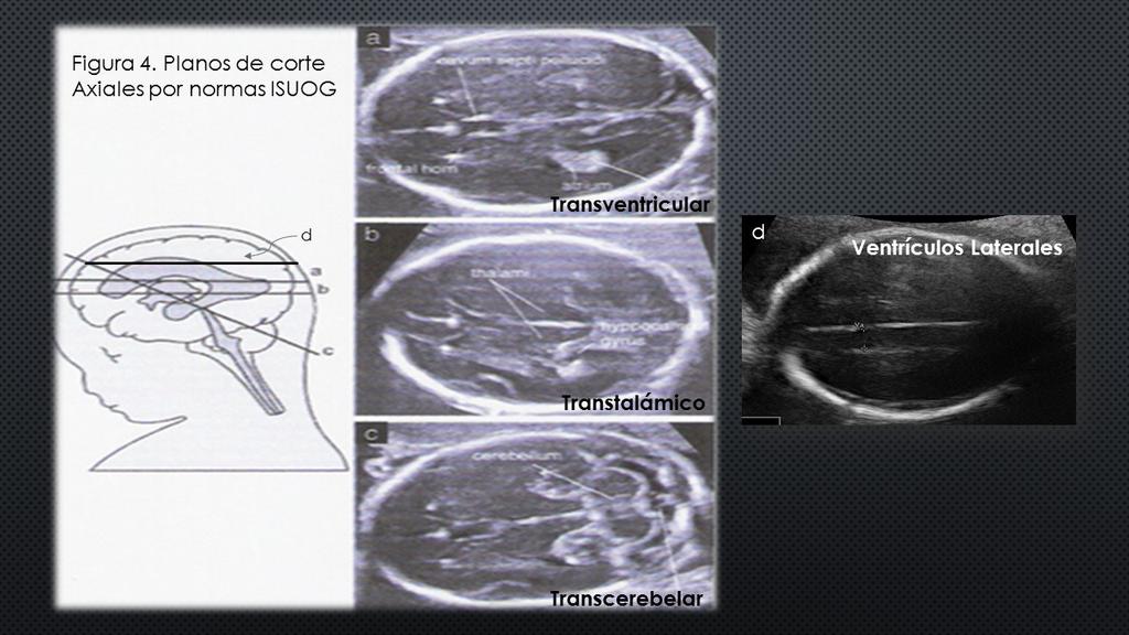 P. HERNÁNDEZ-ROJAS y M. GARCÍA DE YÉGÜEZ Figura 3 Planos de medición del cavum del septum pellucidum (A) y ventrículos laterales en su porción súpero-anterior (B).