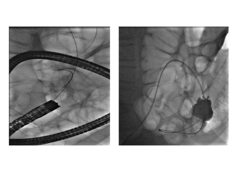 Fig. 7: En la imagen de la izquierda se observa la introducción del colonoscopio vía endorrectal con guía atravesando la