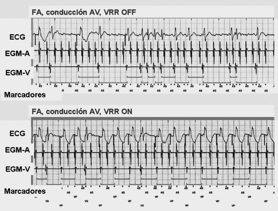 I. Marcapasos definitivo a. b. Fig. 6. Regulación de la frecuencia ventricular (RFV). Paciente con FA; al activar la RFV, se observa una regularización en la frecuencia ventricular.