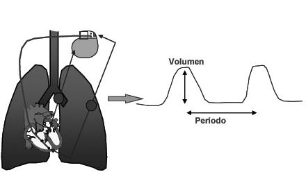 Módulo 6 Fascículo Nº 1 2011 Fig. 7. Sensor de volumen minu to respiratorio.