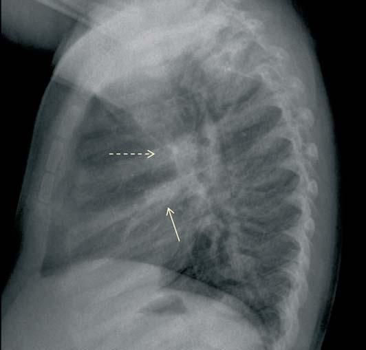 La radiografía de tórax tiene un papel fundamental en el diagnóstico.