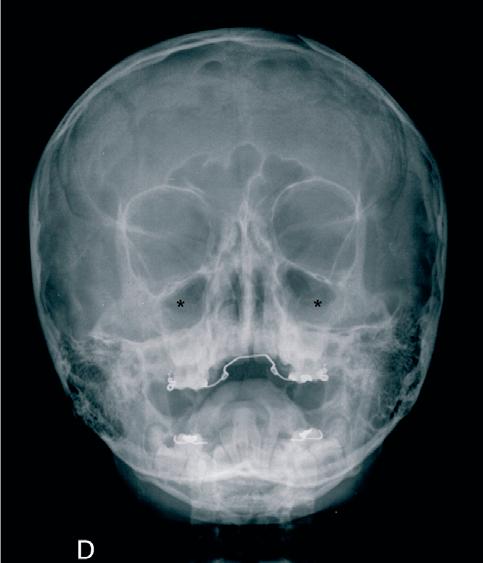 Figura 1. Rx de senos en niño de 10 a. Engrosamiento mucoperióstico en ambos senos maxilares ( * ). sinusitis?, mucosa redundante? Figura 2.