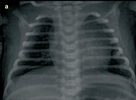 Al timo lo veremos como un ensanchamiento mediastínico, bilateral y de bordes bien definidos, que se confunde con la silueta cardiaca (Figura 6).