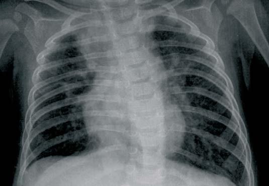Si la infección afecta al intersticio pulmonar (neumonitis intersticial), en la radiografía veremos una afectación intersticial retículo-nodular (Figura 10) o áreas difusas de aumento de densidad,
