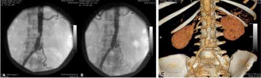 REVASCULARIZACIÓN ENDOVASCULAR Figura 1. Angiografía convencional. Estenosis de la aorta abdominal más lesión oclusiva de la arteria ilíaca izquierda (panel A).