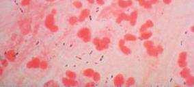 Factores de Virulencia de Streptococcus pneumoniae ADHESINAS: interactúan con receptores disacáridos en la superficie del epitelio