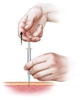 Una vez que la aguja esté totalmente adentro (aproximadamente 1/8" de la aguja aún debe ser visible por encima de la piel), tire del émbolo para revisar si hay sangre.