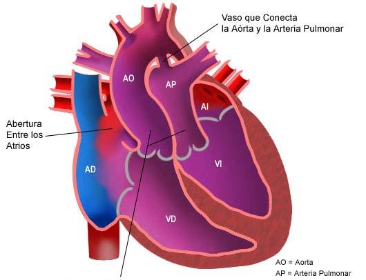 CC CIANÓTICA MÁS FRECUENTE EN EL NEONATO DTGV 2- Hiperflujo Pulmonar D-Transposición de los GV A