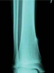 vasculares distales ni impotencia funcional (figura 1). Se solicita una radiografía simple de la pierna afecta, anteroposterior y lateral, donde se visualiza una lesión de carácter óseo (figura 2).