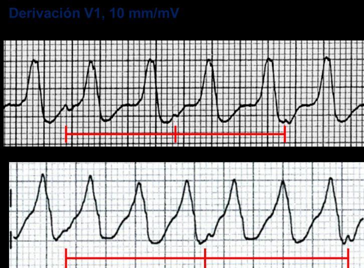 3) Mayor número de QRS que ondas P: taquiarritmia ventricular.
