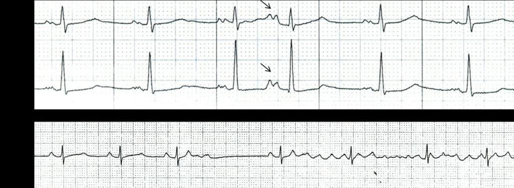 Taquicardia de complejo QRS estrecho irregular Fibrilación auricular (algoritmo E) Los ciclos RR son completamente irregulares y éste es su rasgo distintivo.