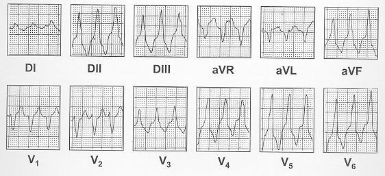 Taquicardia ventricular sostenida La taquicardia ventricular (TV) se origina por definición por debajo de la bifurcación del haz de His.