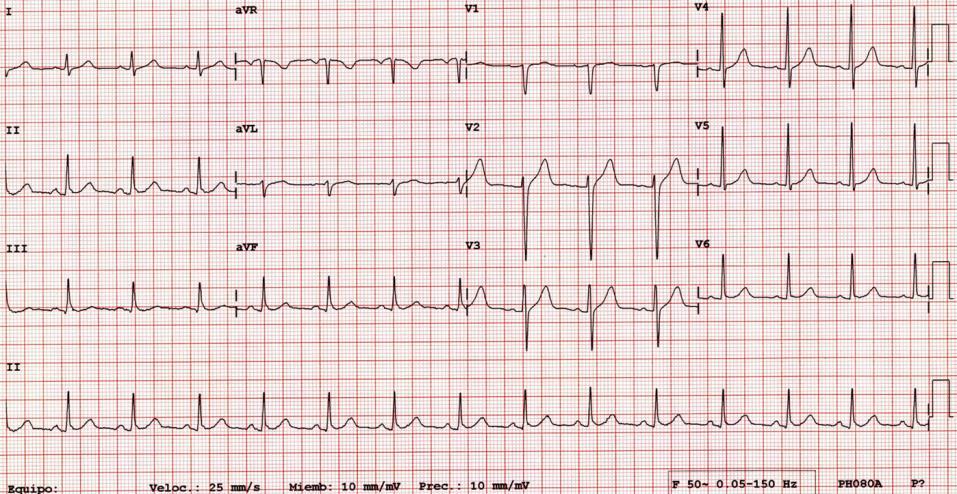 C. Adquisición de la señal y despliegue del electrocardiograma Existen dos formas de recoger la señal eléctrica del paciente: secuencial o simultánea.