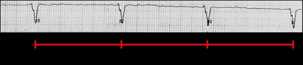 En el ejemplo el ritmo dominante es de escape nodal o ventricular alto secundario a una fibrilación auricular bloqueada.