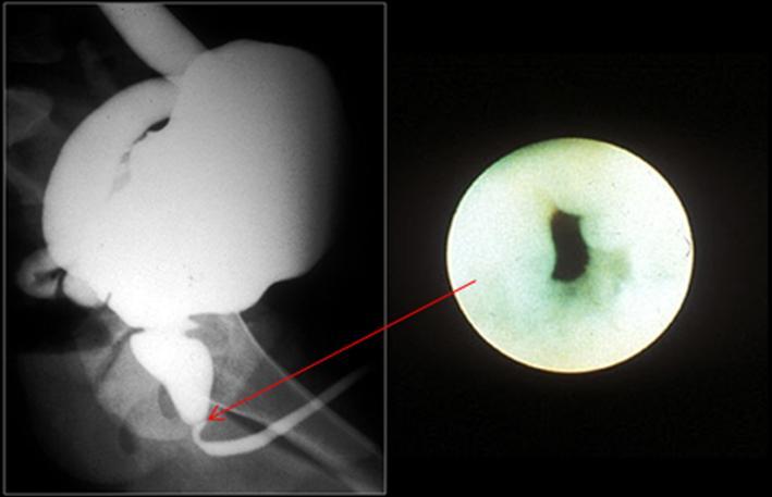 Introducción Las válvulas tipo III son menos frecuentes que las tipo I (5% de los casos). Se han encontrado a diferentes niveles de la uretra y no tienen relación con el veru montanum.