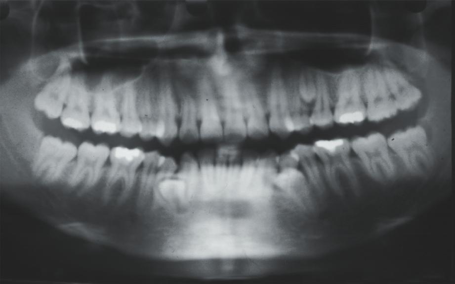 extensión suplementaria o irregular de la lamina dental normal, que aparece por lingual de las dichas láminas después de la formación de los folículos primarios y permanentes; esto explicaría la