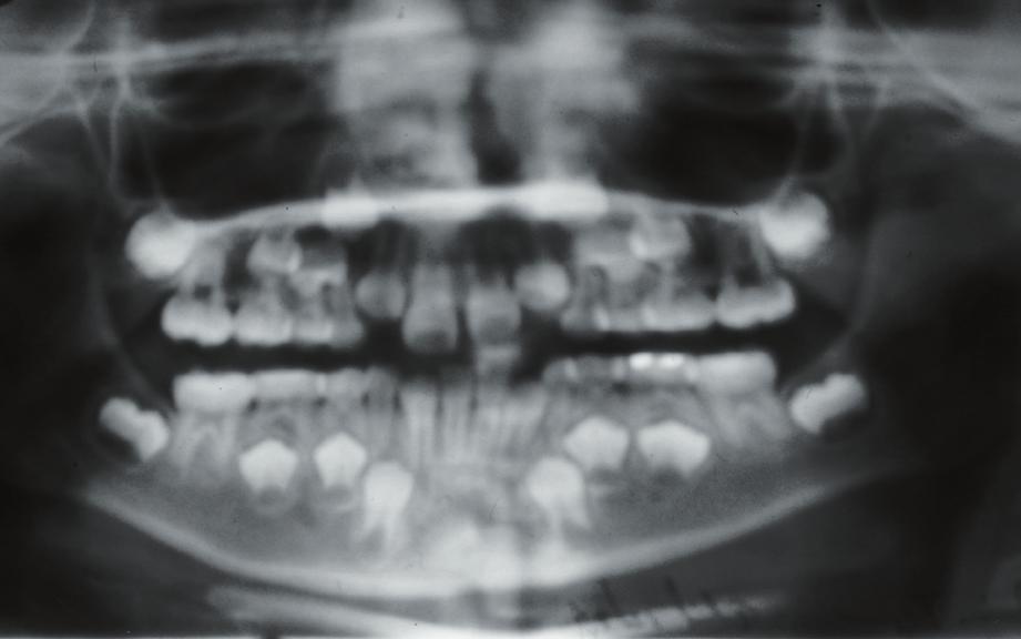 La radiografía panorámica de norma el inicio de la dentición mixta y periódicamente cada 4 o 5 años se constituye en la fuente mas confiable para el diagnostico oportuno de este tipo de anomalías (6).