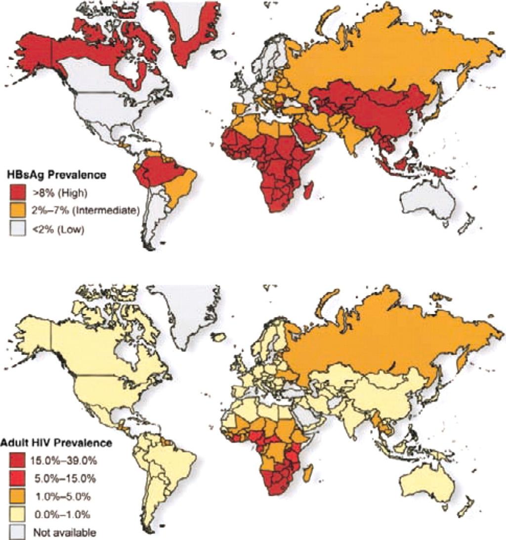 Distribución de la infección por VHB y VIH en el mundo Un 6-14% de personas infectadas por VIH están co-infectadas con VHB Levy V, Grant R M