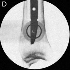 Bajo control radiológico, coloque la punta de la broca oblicua con respecto al eje de radiación e introdúzcala en la incisión, hacia la tibia, hasta que la punta de la broca quede centrada en la