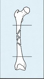 Técnica de enclavado femoral Fracturas femorales con soporte óseo (fracturas estables en el tercio medio del fémur,