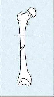 bloqueo Fracturas femorales sin soporte óseo (fracturas inestables en el 60% de la longitud del fémur): Fracturas