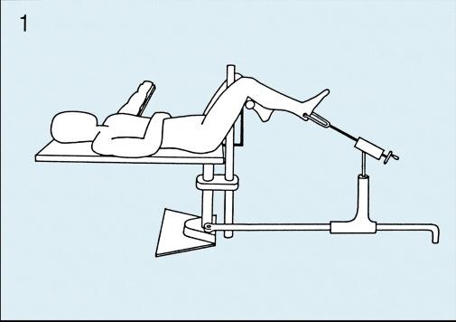 Consideraciones preoperatorias (cont.) 1 Colocación sobre una mesa de tracción Coloque al paciente en decúbito supino, con la rodilla de la pierna lesionada en flexión de 90.