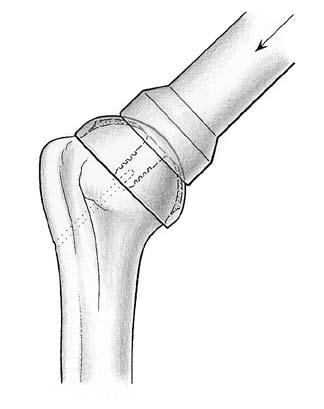 12 Cotilo de hombro Durom Técnica quirúrgica Cementación La prótesis se puede aplicar de dos formas: 1. 1. Se retira la aguja de Kirschner tirando de ésta hacia arriba antes de la cementación. 2.