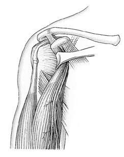 Cotilo de hombro Durom Técnica quirúrgica Practique una incisión en la fascia clavipectoral lateral al tendón del bíceps y al tendón del coracobraquial. Mantenga los tendones desplazados hacia medial.