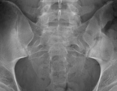 of both SI joints (arrows) Note sclerosis on iliac side Tercio medio